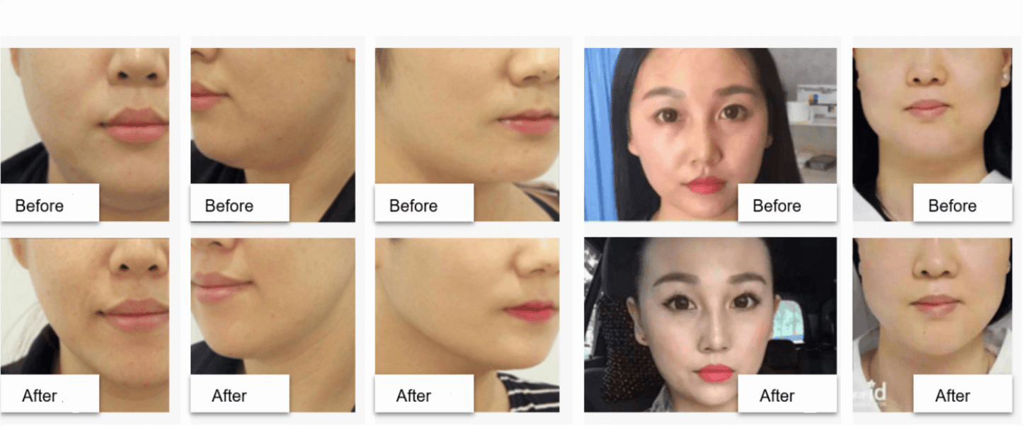 Before and after images showing the effects of Super V Line Sol on defining the jawline and reducing submental fat at Nutrination.