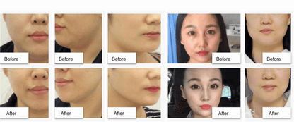 Before and after images showing the effects of Super V Line Sol on defining the jawline and reducing submental fat at Nutrination.